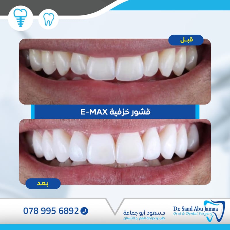 القشور الخزفيه e max