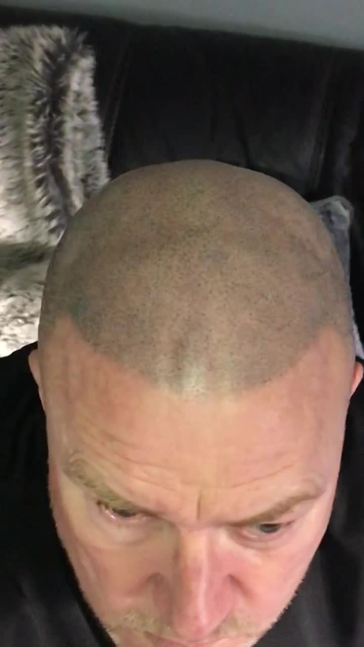Scalp Micropigmentation video thumbnail
