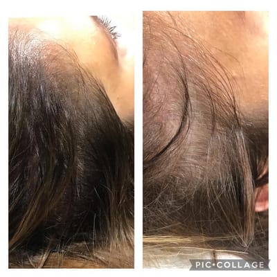 Scalp Micropigmentation image