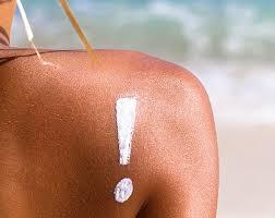 How To Treat Sunburn - Naturally