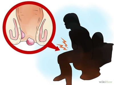 Obat Wasir Pereda Pembengkakan Benjolan Meradang
