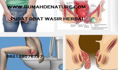 Cara Menghilangkan Benjolan Wasir Di Dubur Yang Sudah Parah