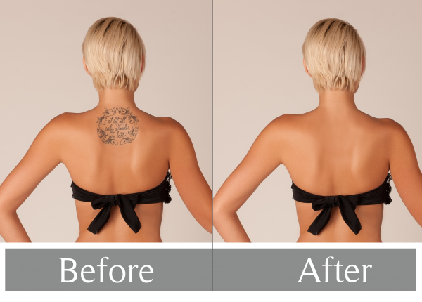 Laser Tattoo Removal: What You Need To Know Before Laser Treatment