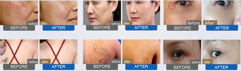 Shattering pigmentation and tattoo removal with Picosecond Laser Sydney