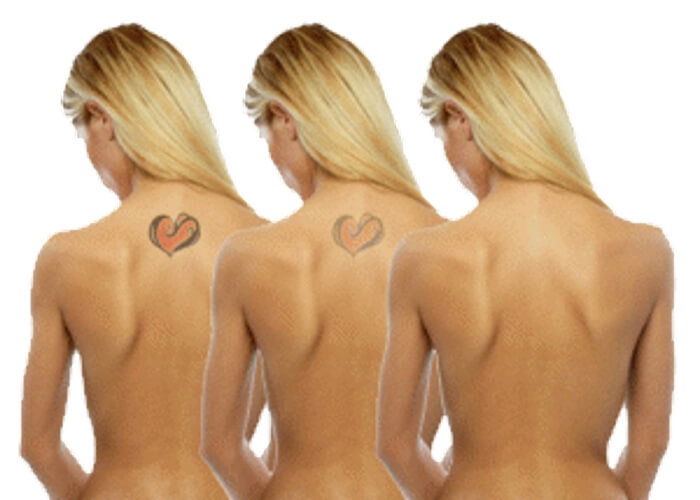 Dissipate unwanted tattoo art with laser tattoo removal Sydney
