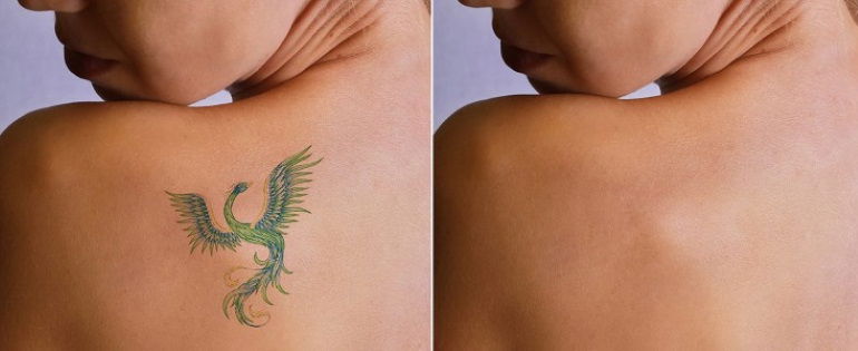 Expunge unwearable tattoos with Laser Tattoo Removal Sydney