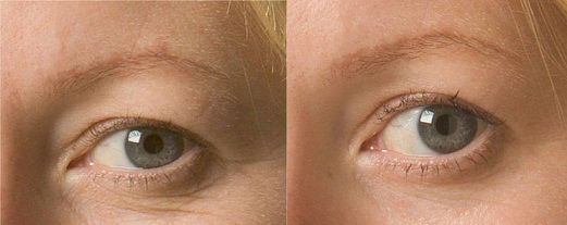 anti-wrinkle facial in Sydney