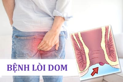 Tìm hiểu bệnh lòi dom có nguy hiểm không?