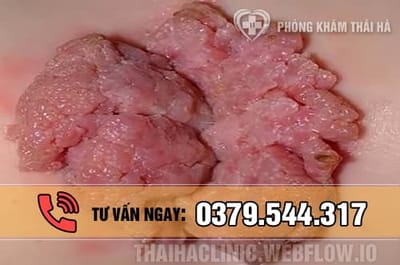 Sùi mào gà giai đoạn đầu có tự khỏi không