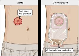 What is Ostomy