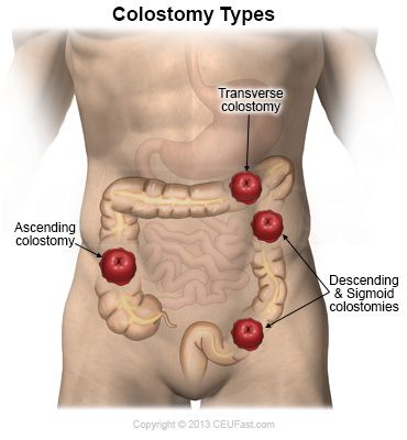 Colostomy