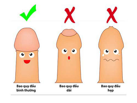 Tieu phau cat bao quy dau co may buoc?