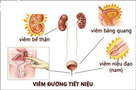 Phuong phap chua viem tiet nieu tai nha hieu qua