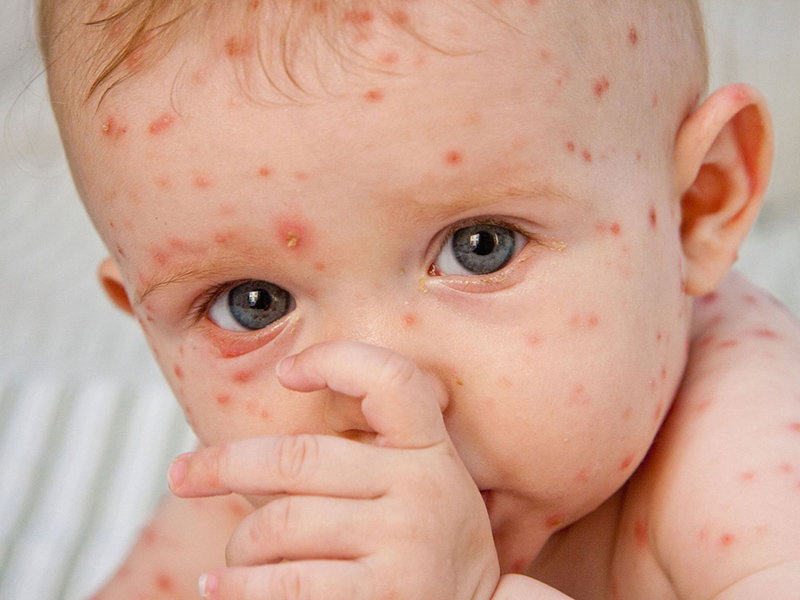 Tìm hiểu những nguy hiểm của bệnh Rubella