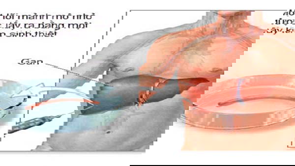 sinh thiet gan va nhung dieu can biet