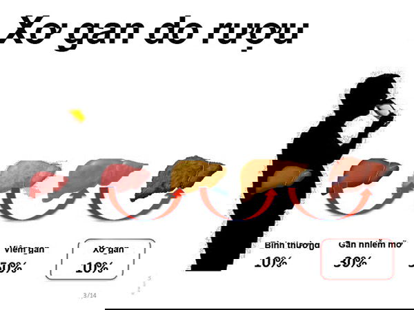 Viem gan do ruou bia: trieu chung, dieu tri