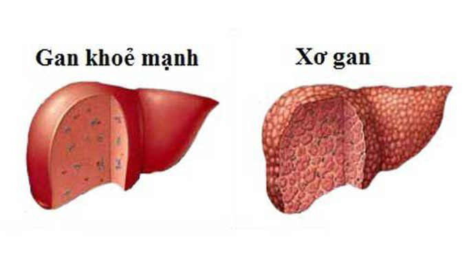 Xo Gan: Trieu chung, nguyen nhan, dieu tri