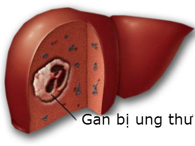 Ung thu bieu mo te bao gan