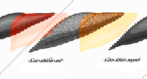 Benh gan nhiem mo khong do ruou