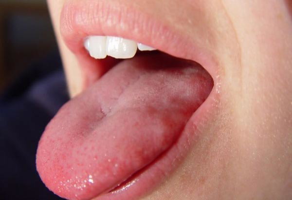 Trieu chung sui mao ga o luoi the nao