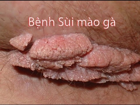 Sui mao ga o nu gioi nhu the nao?