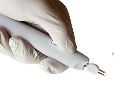 טיפול במחט חשמלית (קאוטריזציה)