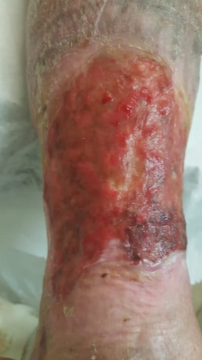 Ulcers on lower legs