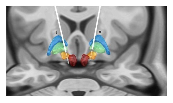 Deep Brain Stimulation (DBS)