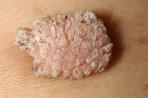 Sùi mào gà lây qua đường nào?