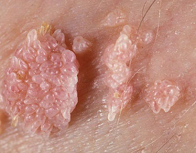 Benh sui mao ga lay qua quan ao khong