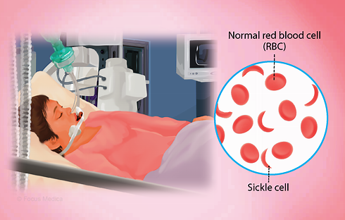 Sickle cell anaemia