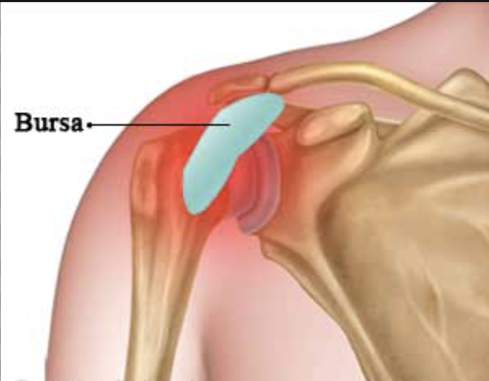 Bursitis