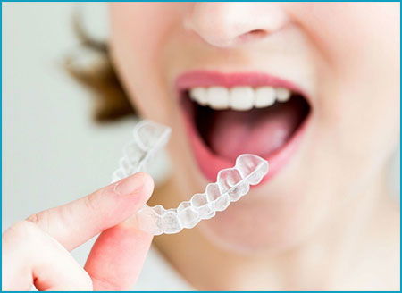 Tại sao nên lựa chọn niềng răng Invisalign thẩm mỹ