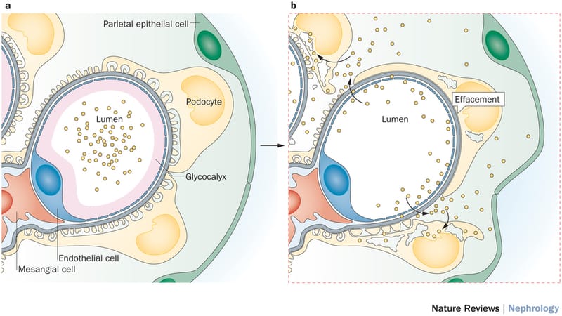 Which is te best treatment for ADPKD in stage 5