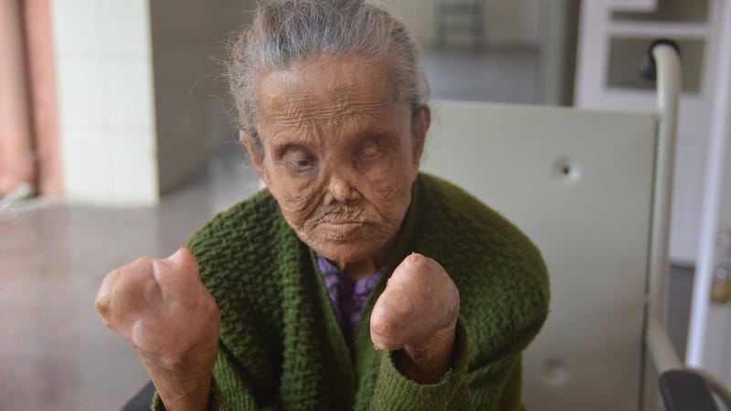 Give Tet gifts to patients at Ben San Leper Hospital