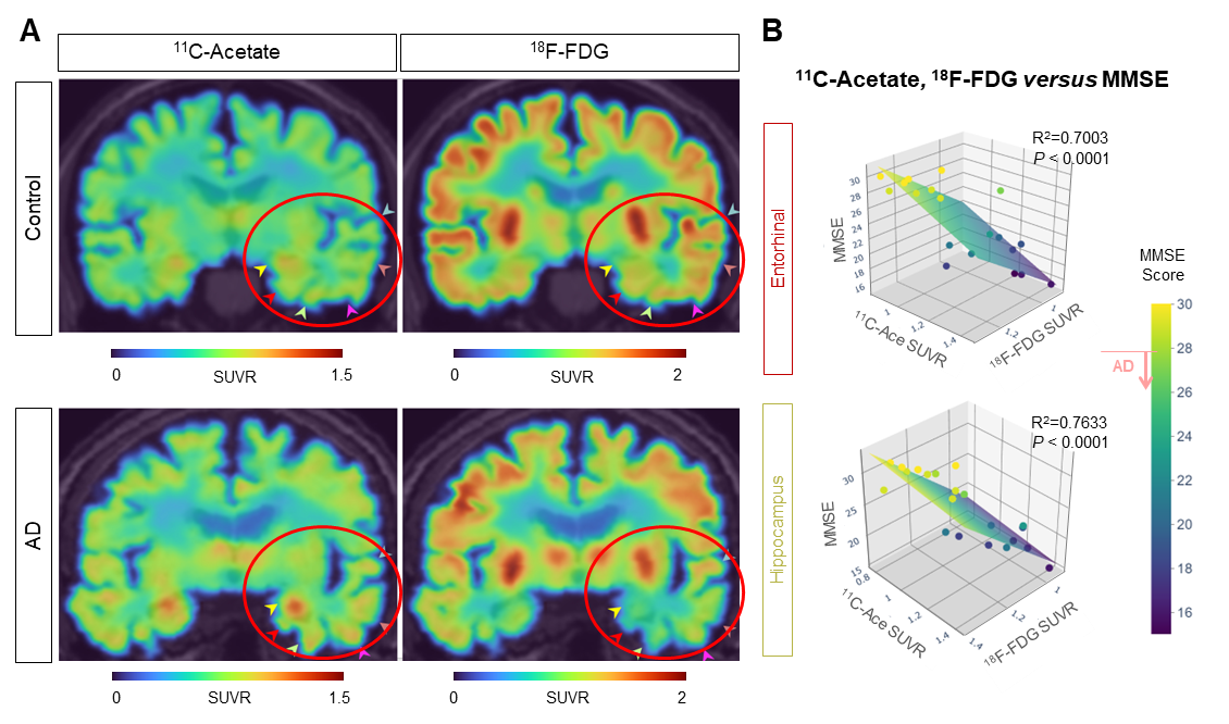 A new breakthrough in Alzheimer's disease research: visualizing reactive astrocyte-neuron interaction