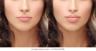 Lip Augmentation Injectable Fillers