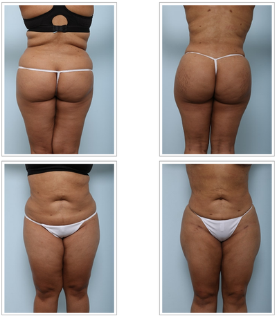 Buttock Augmentation in Dubai