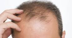 hair loss treatment in Dubai
