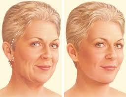 What Should You Look Out For in Face-Lift Surgery?