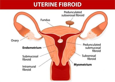 Fibroids and Infertility – Symptoms of Fibroids and How to Treat Fibroids