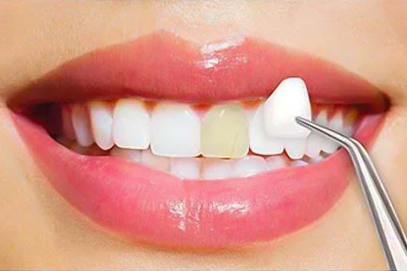 Dental Bonding Vs Veneers: Know The Difference