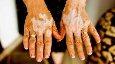  Disease 3: Vitiligo image