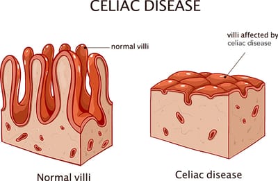Disease 4: Celiac disease image