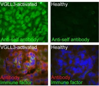 The future of autoimmune disease. image