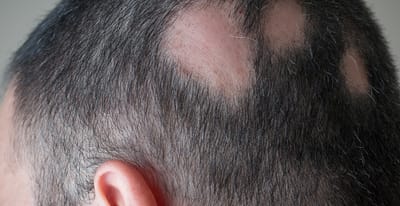 Disease 2 : Alopecia image