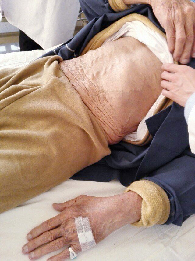 فمن الممكن بالنسبة لك للحد من مرات غسيل الكلى أو حتى تجنب غسيل الكلى