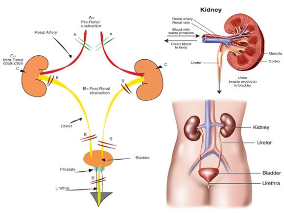 من أجل الحصول على علاج فعال لمرحلة الفشل الكلوي 5