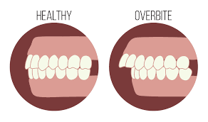 What Are The Problems Caused By An Overbite?