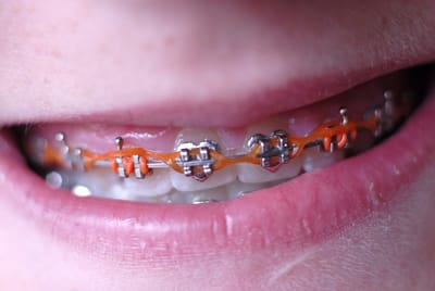 What are Orthodontic Elastics?